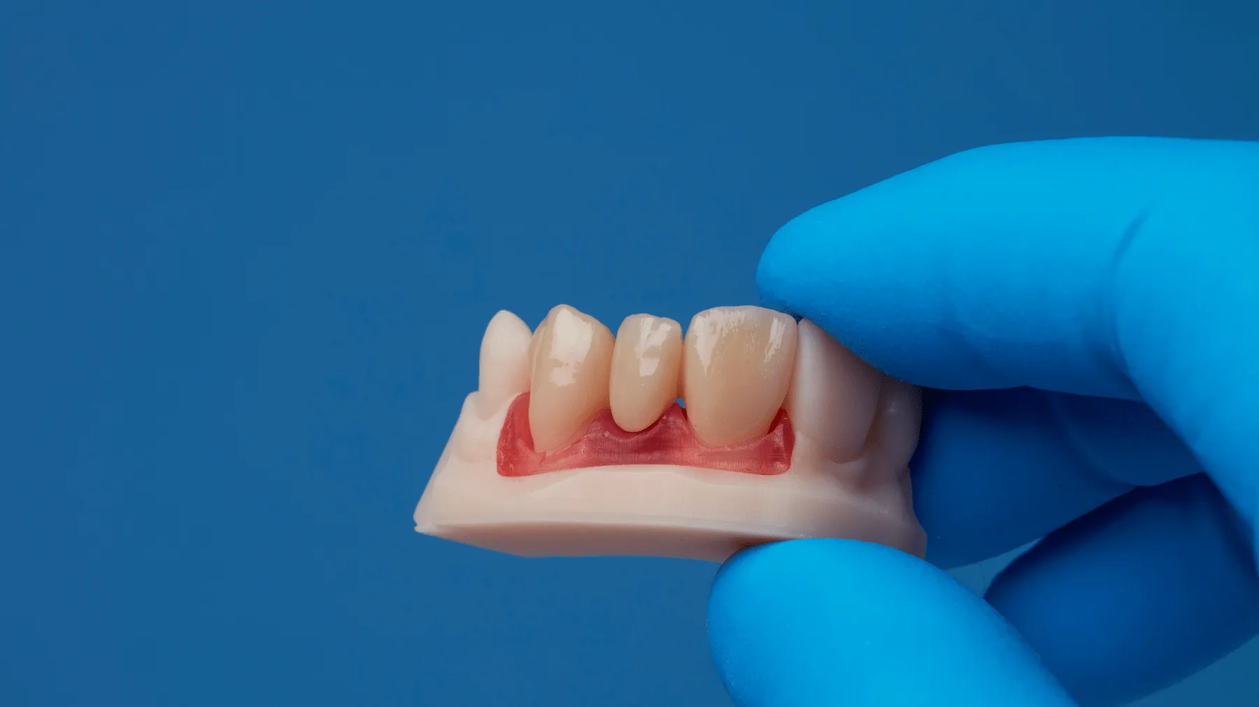 Corona de zirconio fabricada con flujo digital CAD-CAM