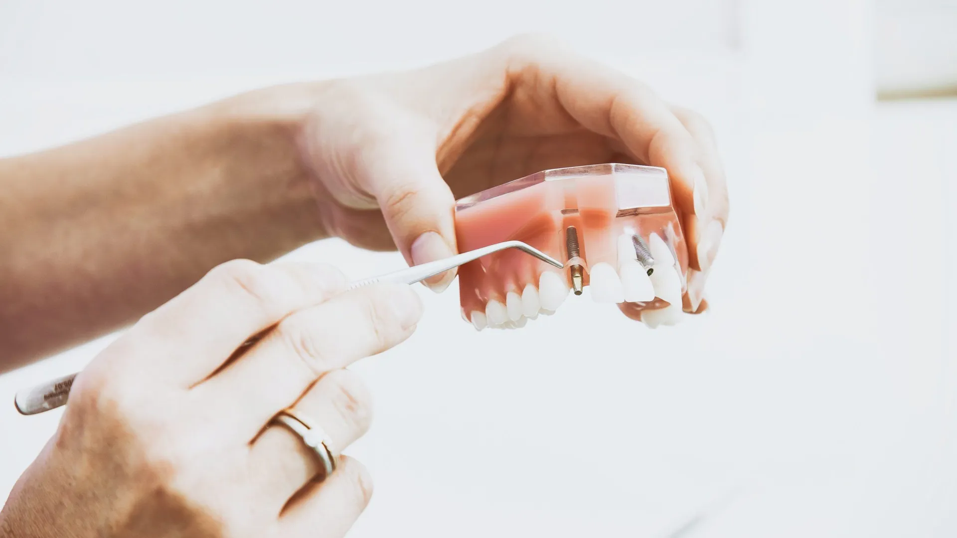 Prótesis fija sobre implantes fabricada con protocolo digital