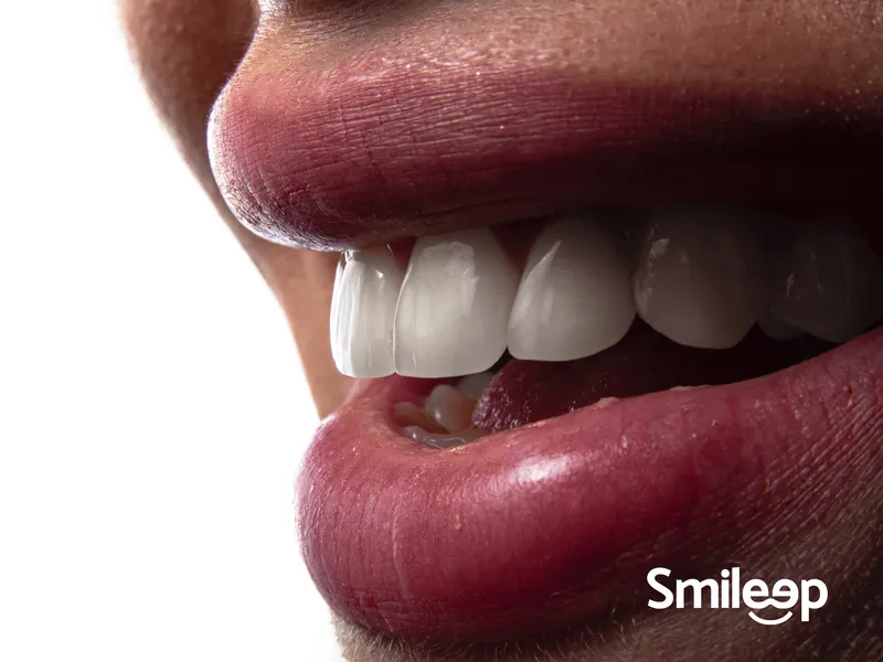 Revisión digital del diseño de carillas dentales antes de fabricar